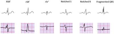 QRS Fragmentation Patterns Representing Myocardial Scar Need to Be Separated from Benign Normal Variants: Hypotheses and Proposal for Morphology based Classification